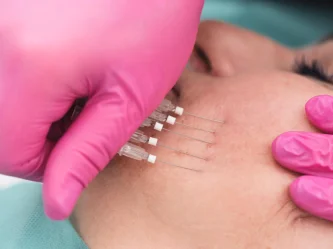 Thread lift: How it works, who it's for, and what to expect