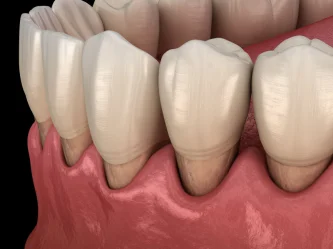 Gingival recession: Causes, risks, and effective treatments