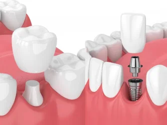 Puente o implante dental: cómo elegir la mejor solución para tu diente perdido
