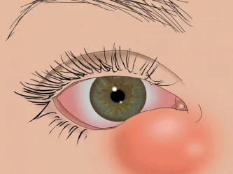 Diga adiós a los ojos llorosos: tratamientos eficaces para la dacriocistitis