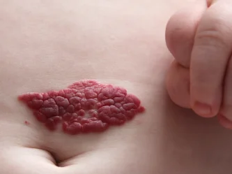 Hemangiomas and heart health: Understanding vascular connections