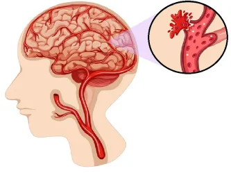 Brain Hemorrhage: Types, Warning Signs, and How Treatment Works