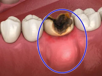 Absceso dental: Todo lo que necesitas saber para proteger tu salud bucal