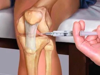Knee infiltration: Relieve your gonarthrosis & regain your mobility