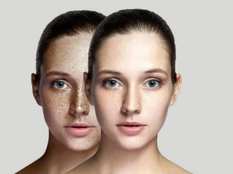 Éliminer les taches brunes du visage : tout ce qu'il faut savoir sur le laser esthétique