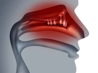 Nasal polyps: Early diagnosis and innovative treatments