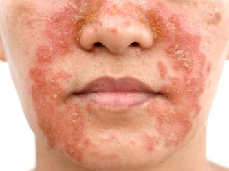 Dermatite et eczéma : identifier et traiter les 4 types principaux