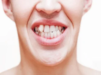 Dientes apiñados: causas, riesgos y tratamientos efectivos en Turquía