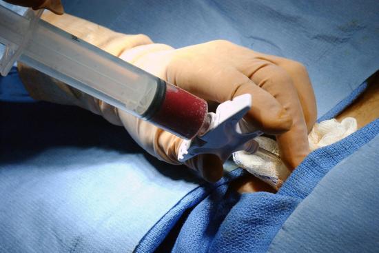 Bone marrow transplant