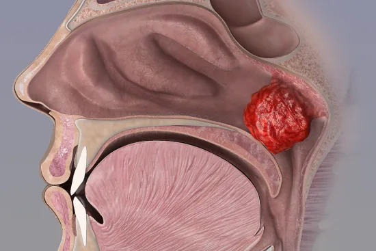 Adenoidectomy