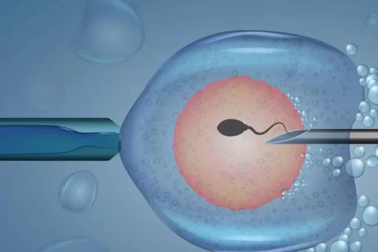 Inyección intracitoplasmática de esperma (ICSI)