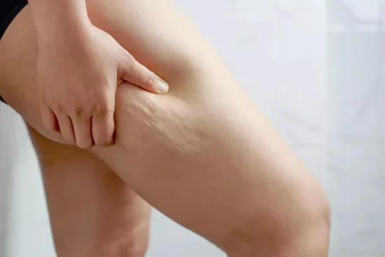 Cirugía del lipedema Cirugía del lipedema