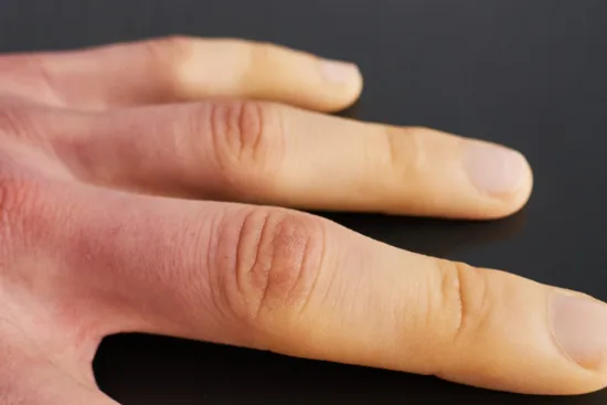 Treatment of scleroderma