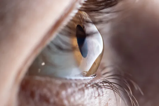 Keratoconus treatment