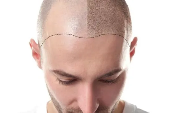 زراعة الشعر زراعة الشعر
