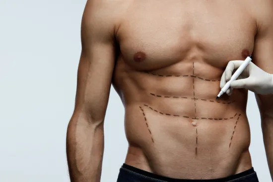 Marcación abdominal Marcación abdominal