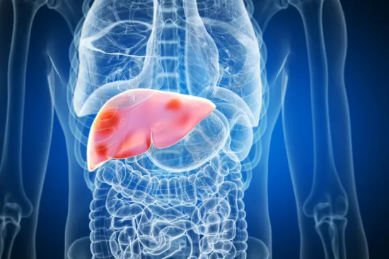 Tratamiento del cáncer de hígado