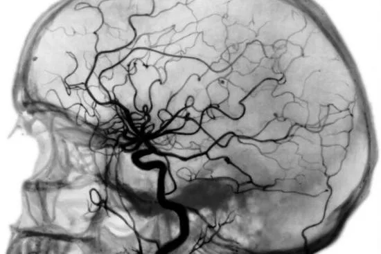 Angiografía cerebral