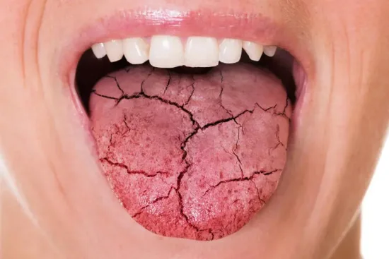 Treatment of tongue cancer