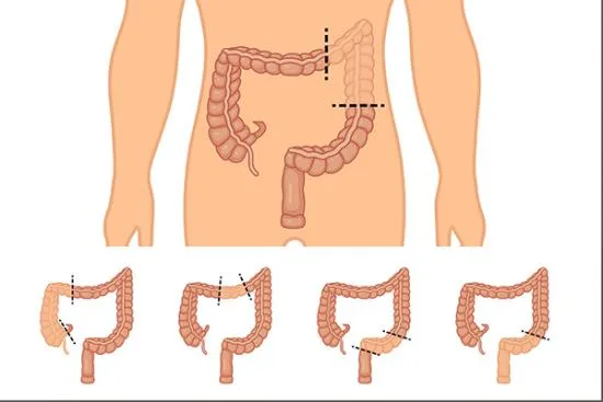 Colectomy