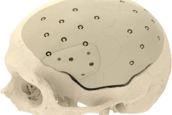 Cranioplasty Cranioplasty