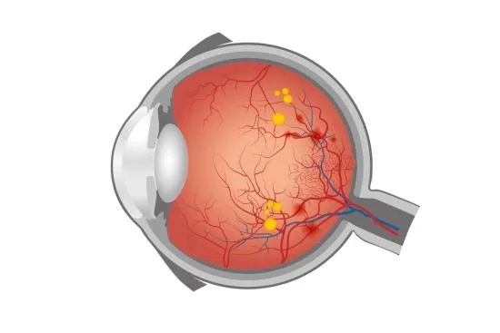 Diabetic Retinopathy Treatment