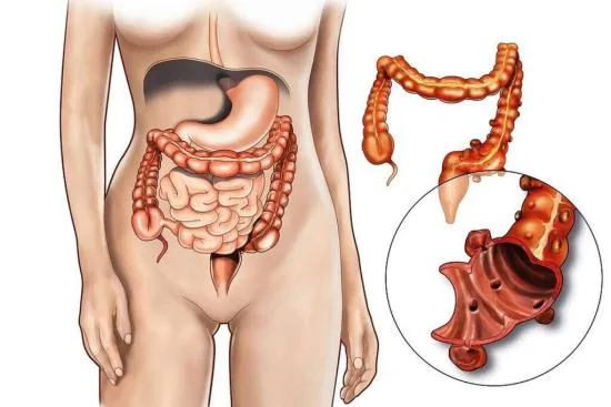 Treatment of diverticulitis