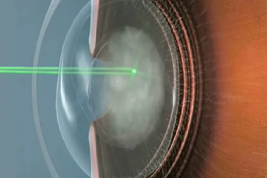 YAG laser capsulotomy