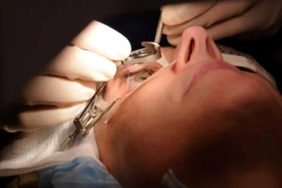 Cornea transplant