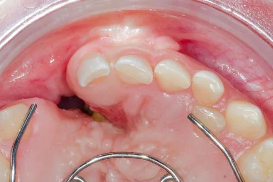 Dental bone graft