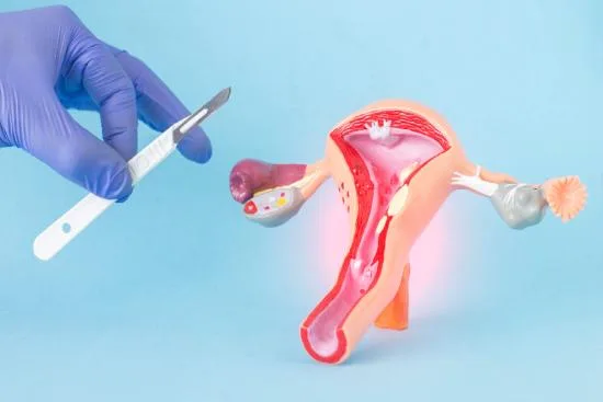Hysterectomy