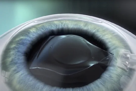 Phakic ICL Implants