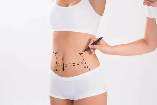 Liposucción Liposucción