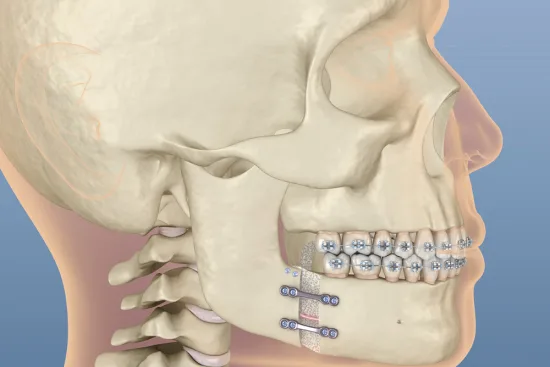 Jaw surgery Jaw surgery