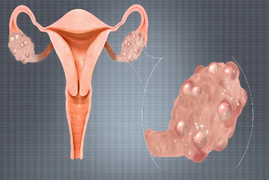 Removal of Ovarian Cysts