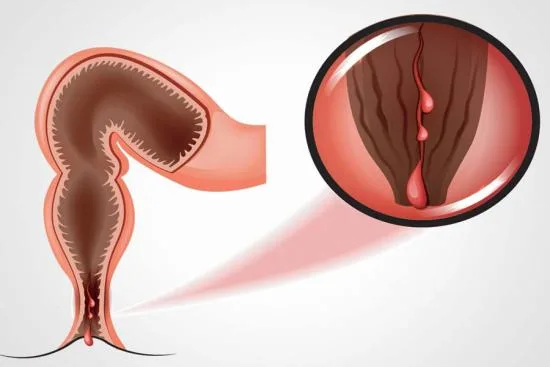 Anal fistula surgery