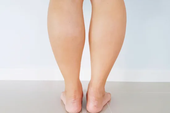 Calf reduction Calf reduction
