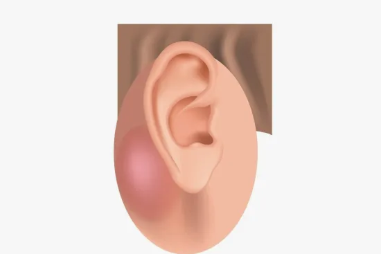 Mastoidectomy