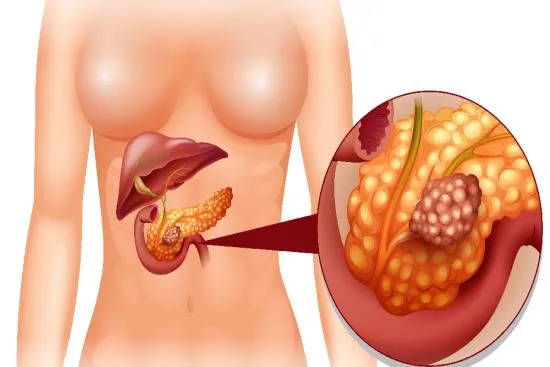 Pancreatectomía total