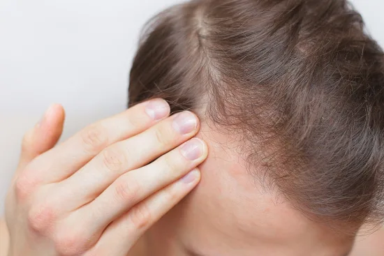 Hormonal hair loss treatment