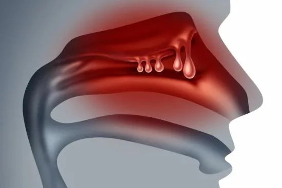 Nasal polypectomy