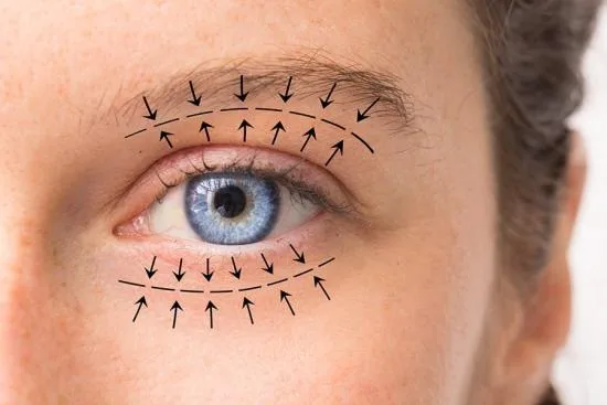 Blepharoplasty Blepharoplasty