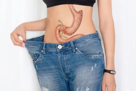 Gastric Sleeve