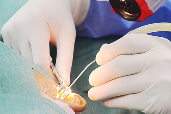 Stapedectomy