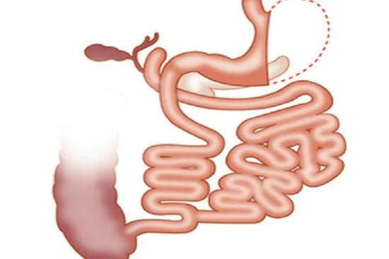 biliopancreatic diversion with duodenal switch