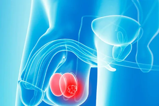 Orchidectomy: Removal of the testicles