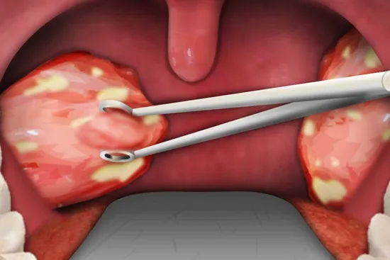 Tonsillectomy