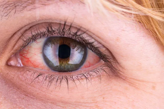 Treatment of uveitis