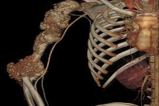 Bone cancer treatment Turkey Bone cancer treatment Turkey