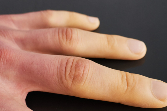 Treatment of scleroderma